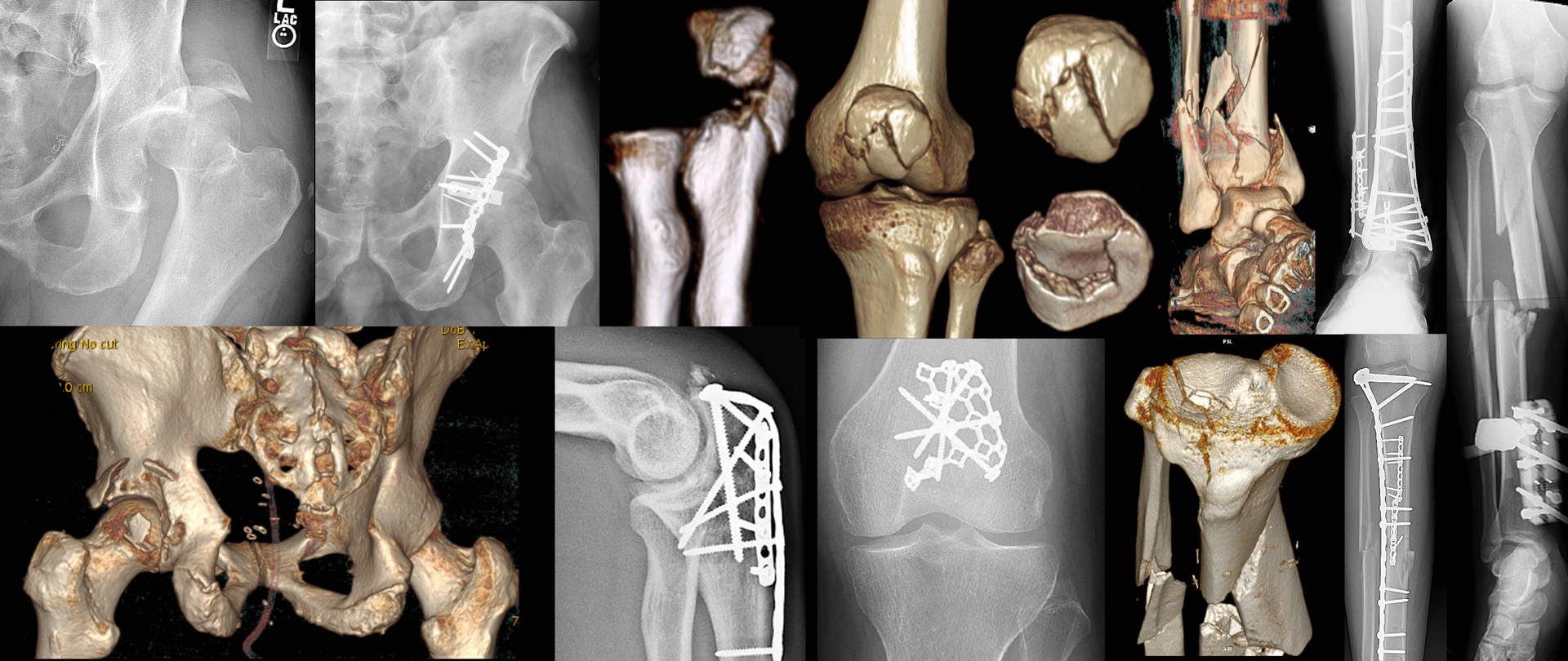 No Fracture Is Too Complex