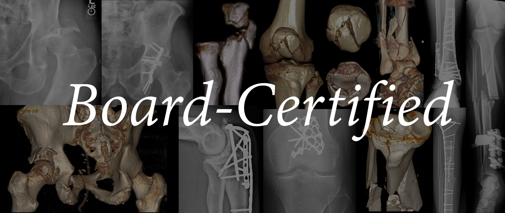No Fracture Is Too Complex