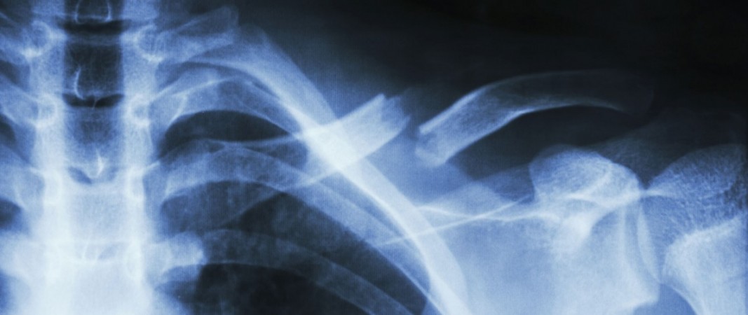 About NY Fracture Care